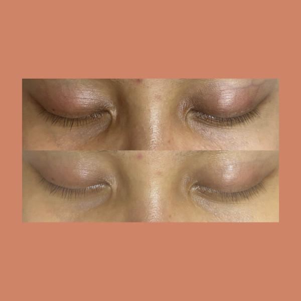 客製淨膚撥筋 $ 3300 元