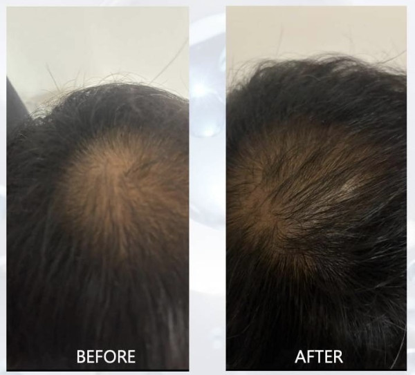 外泌體/SMP 育髮術